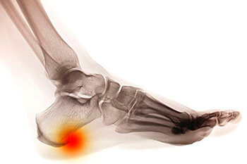 heel spurs