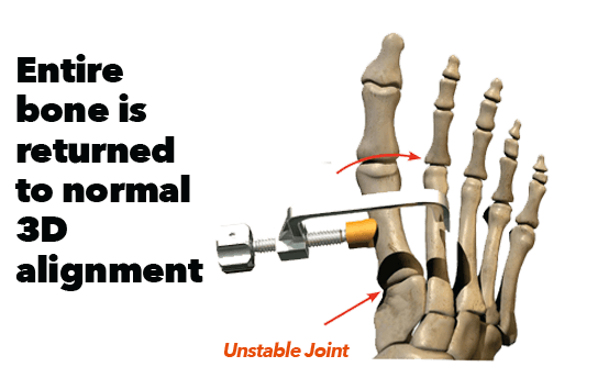 Lapiplasty 3D lapiplasty 3d