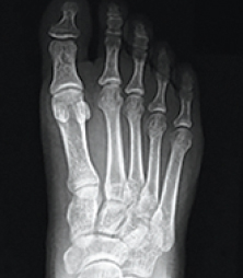 Bunion Treatment xray of bunion
