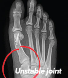 Bunion Correction xray of bunion