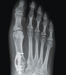 Titanium Plates For Bunion Correction xray of bunions